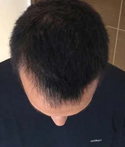 Robert T. scalp at Month 6