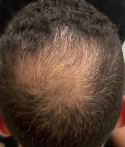Michael B. scalp before treatment