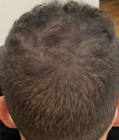 Michael B. scalp at Month 5