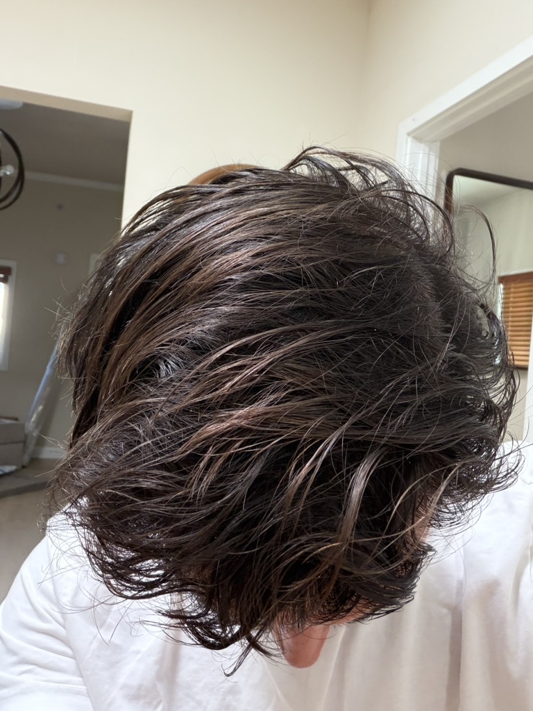 Sam M. scalp at Month 9