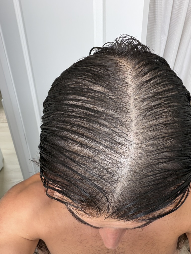 Sam M. scalp before treatment