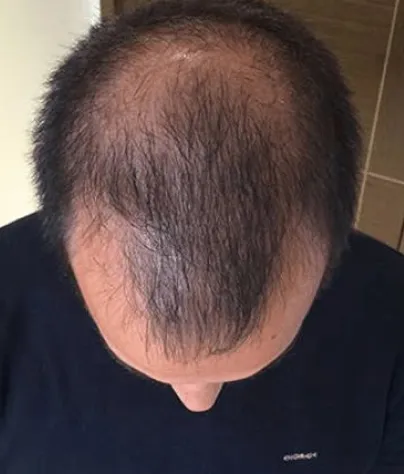 Robert T. scalp before treatment